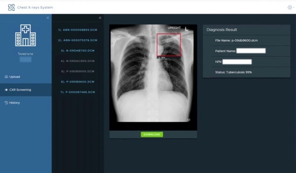 'INET จับมือ 'IBM นำ AI ช่วยตรวจหาวัณโรคจากภาพเอ็กซเรย์ทรวงอกในโรงพยาบาล 75 แห่งทั่วไทย