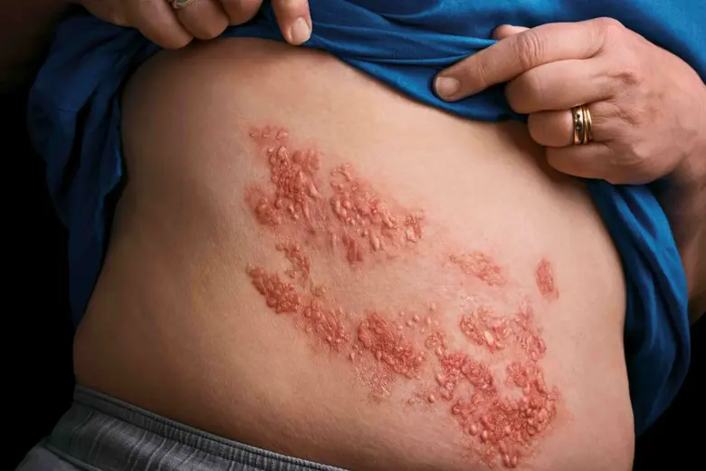 แพทย์ชี้ '1 ใน 3 คน' เสี่ยงเป็นงูสวัดอย่างน้อย 1 ครั้งในชีวิต วัย 50+ และผู้มีโรคร่วม เสี่ยงกระทบสุขภาพรุนแรง