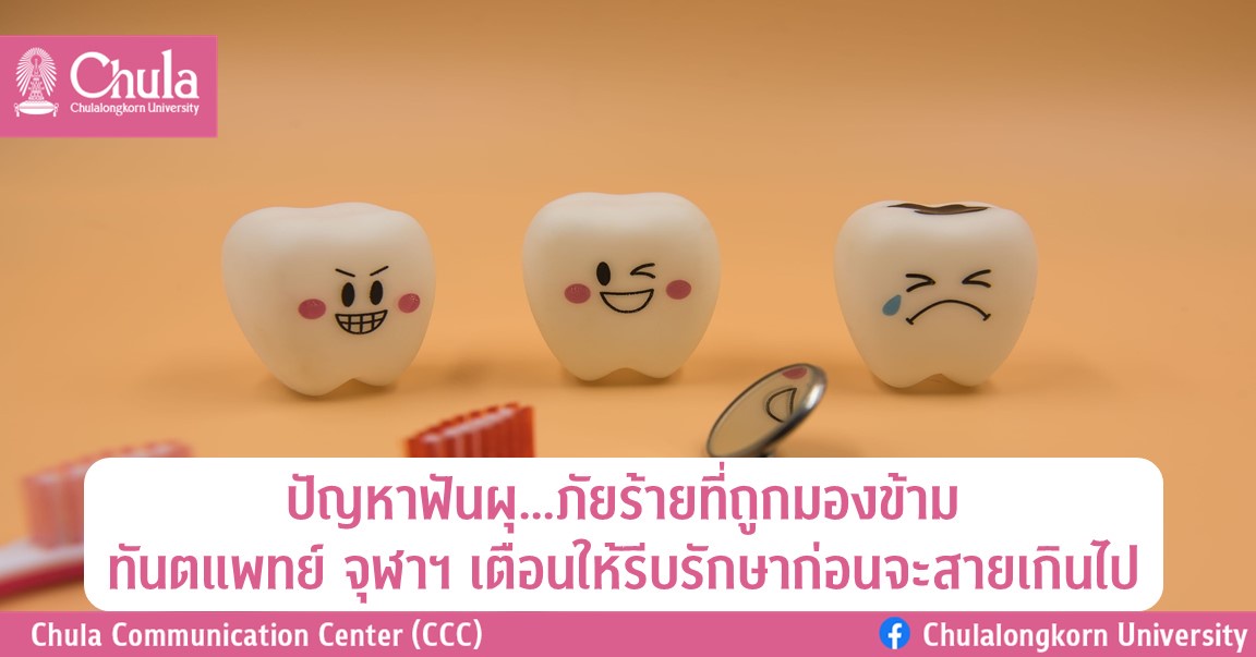 ปัญหาฟันผุภัยร้ายที่ถูกมองข้าม ทันตแพทย์ จุฬาฯ เตือนให้รีบรักษาก่อนจะสายเกินไป