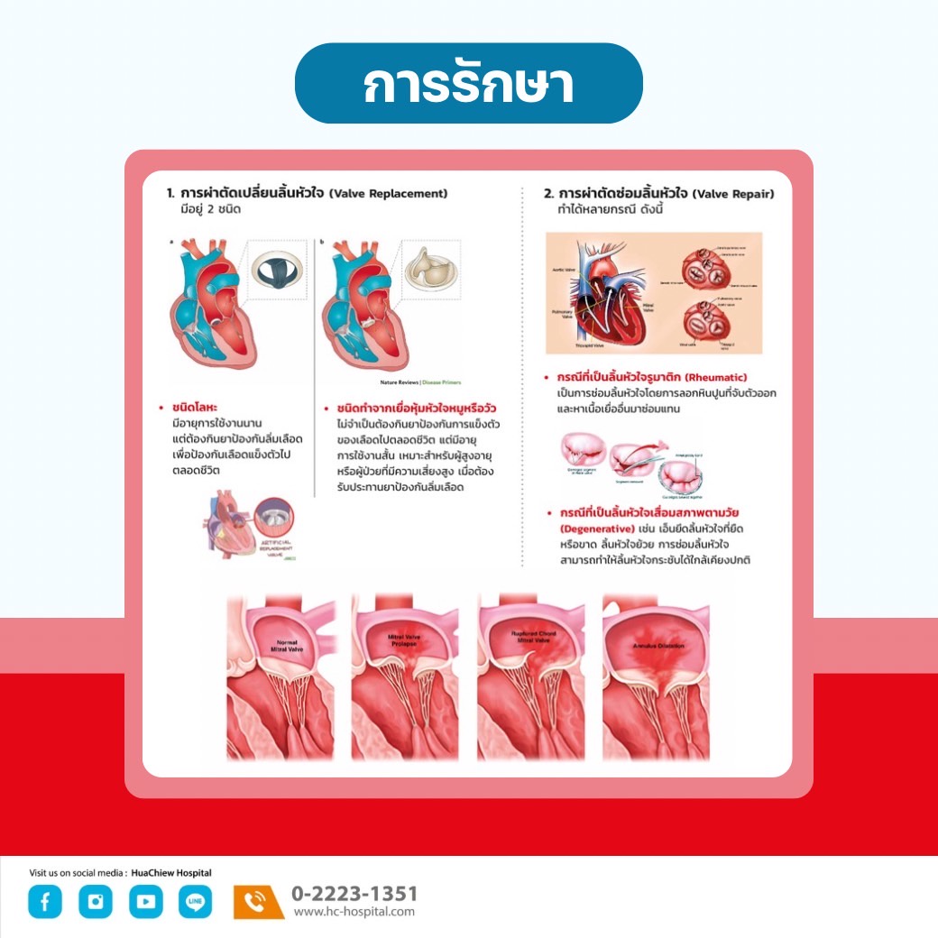 การผ่าตัดลิ้นหัวใจรั่ว