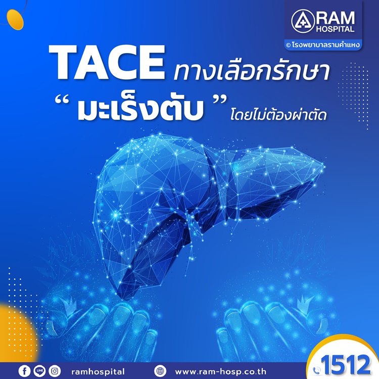 TACE ทางเลือกรักษา มะเร็งตับ โดยไม่ต้องผ่าตัด